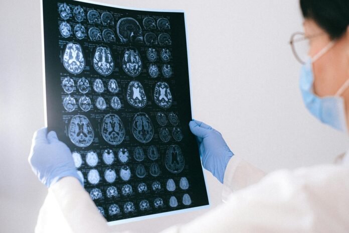 BrainAge: tecnologia indica a idade cerebral
